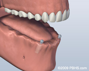 lower jaw all teeth missing with two implants for ball attachment denture