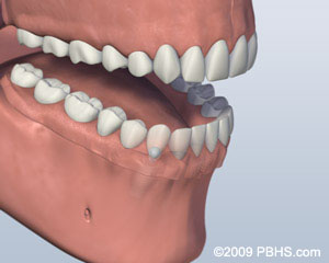 mouth with ball attachment denture latched onto lower jaw by two implants