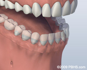 mouth with bar attachment denture secured onto lower jaw by four implants
