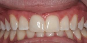Fractured Front Tooth Crown