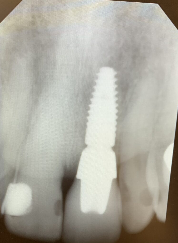 Implant Dentist Hockessin DE
