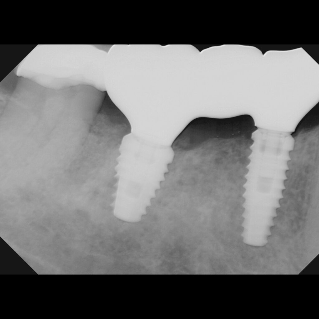 Implant Dentist Hockessin DE