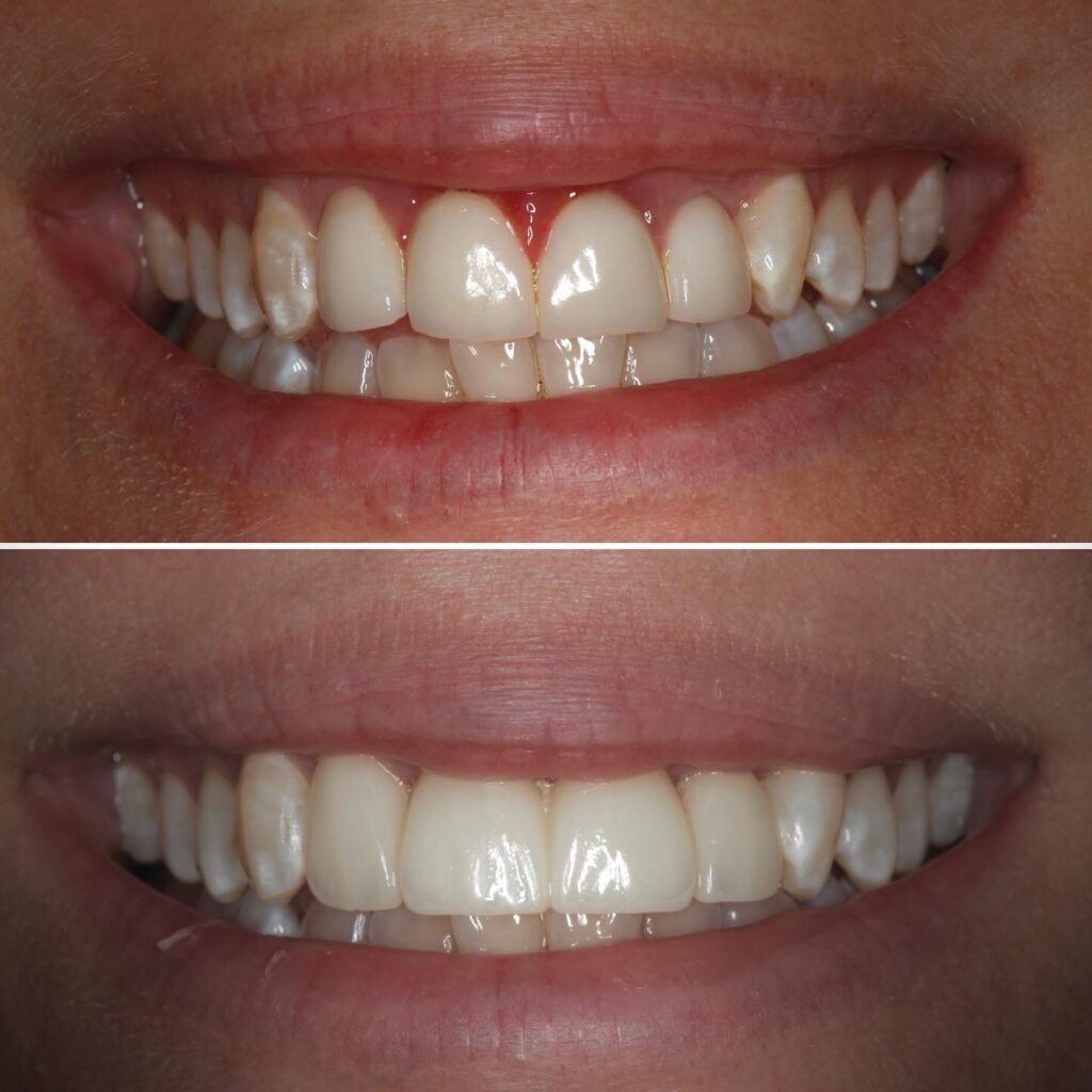 Veneer Replacement