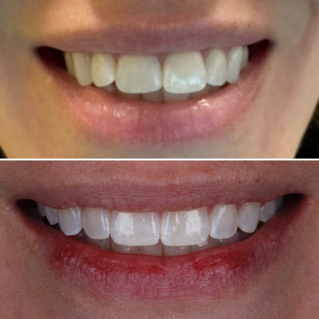 Invisalign