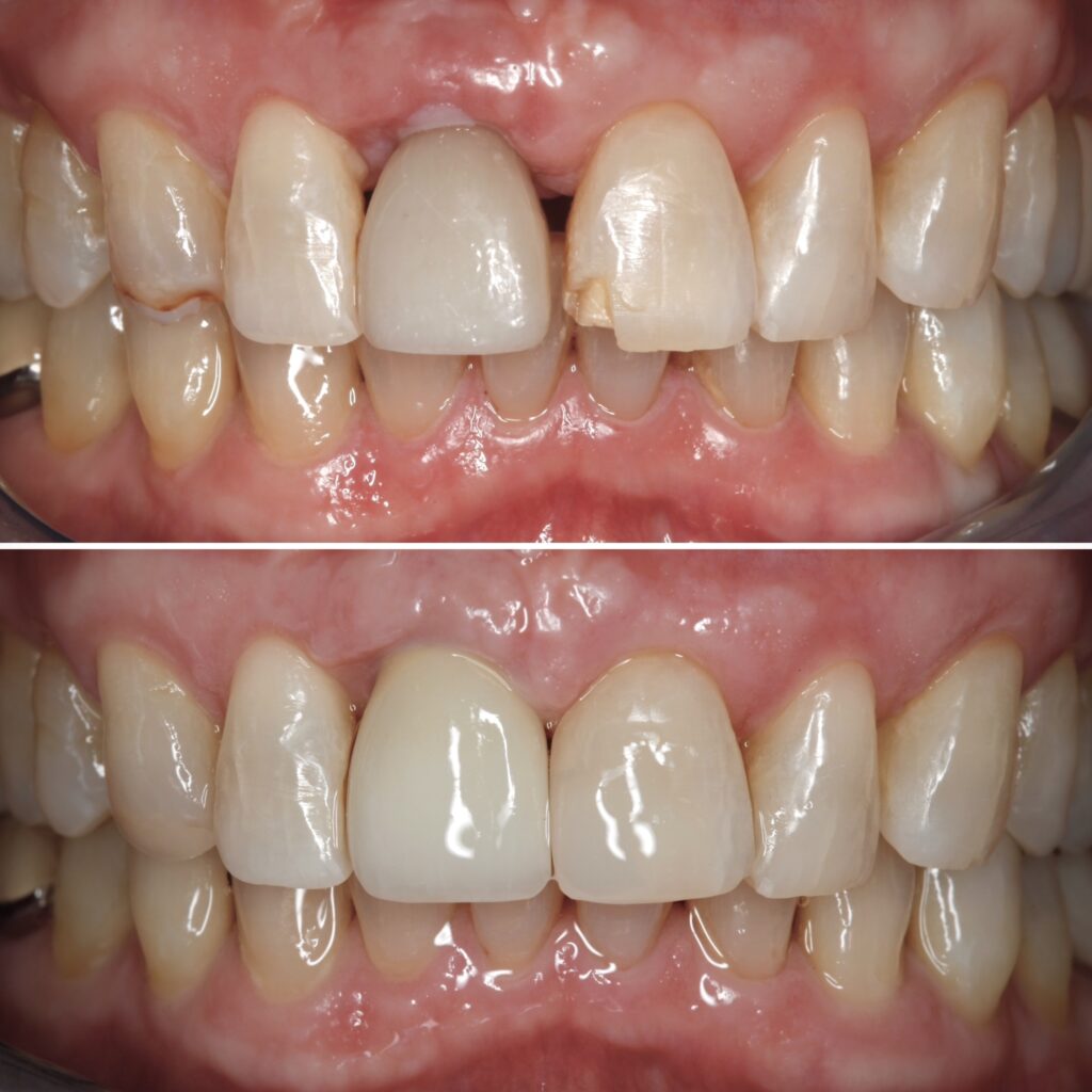 Dental Implant
