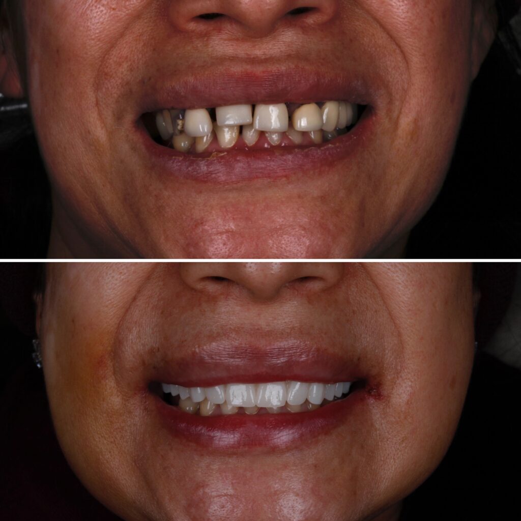 Dental Implants