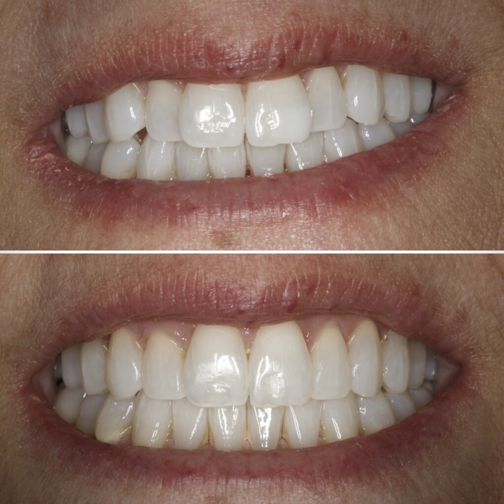 Clear Aligners