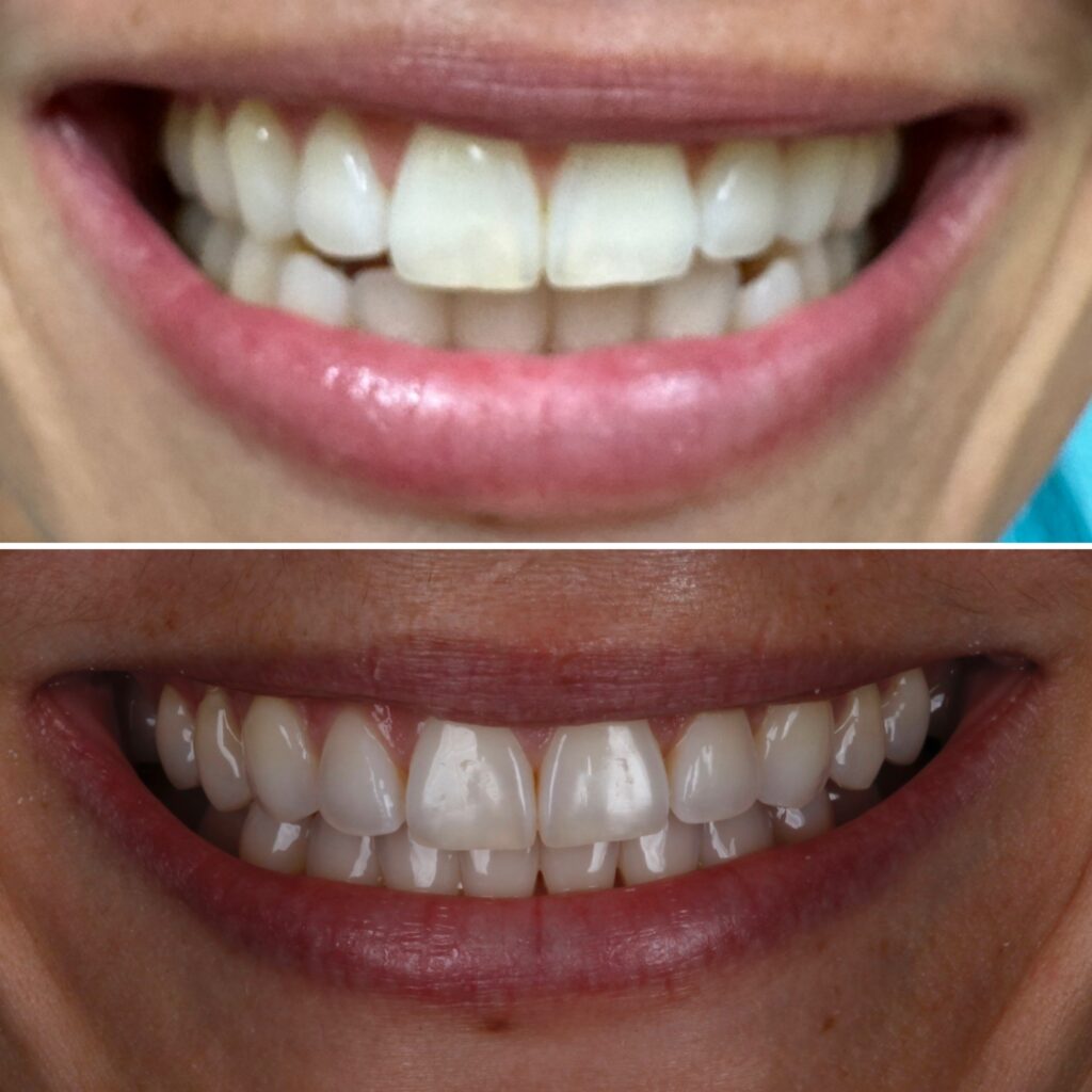 Clear Aligners