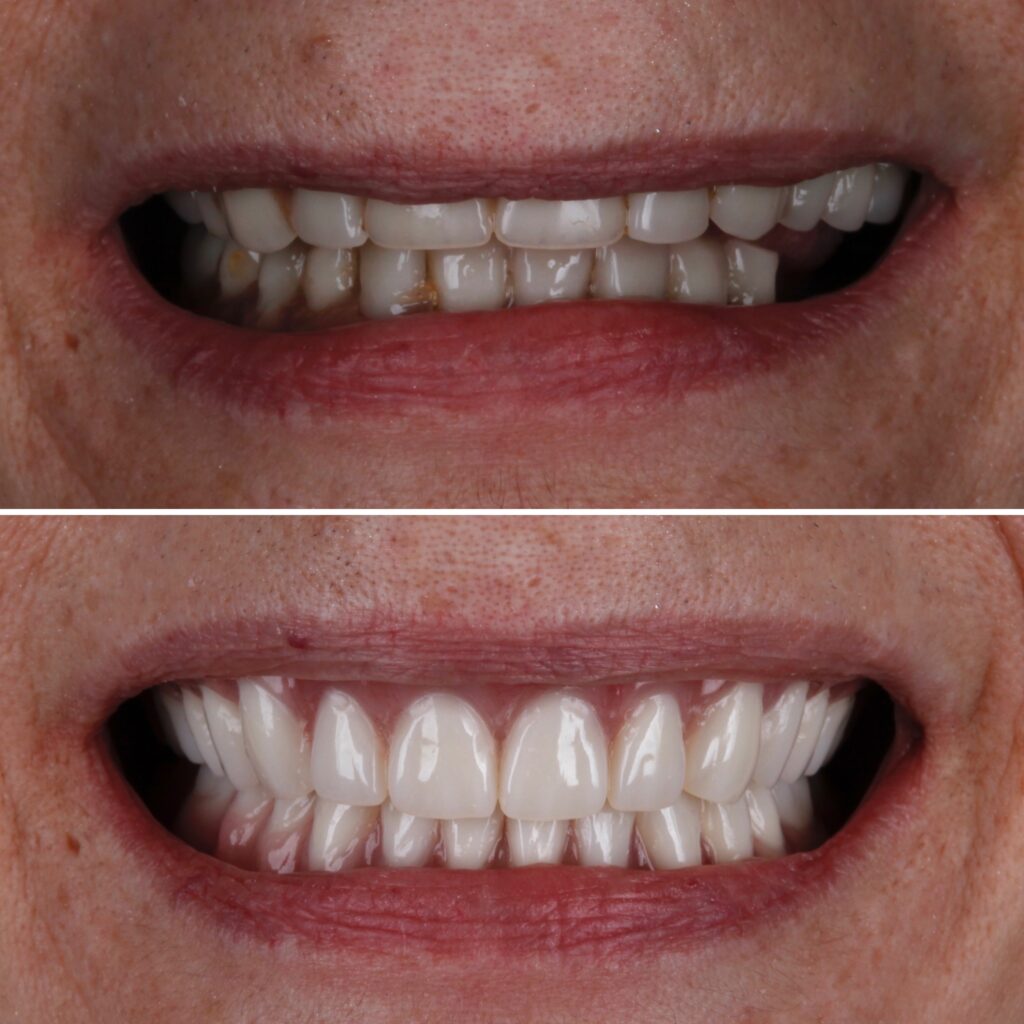 Dentures
