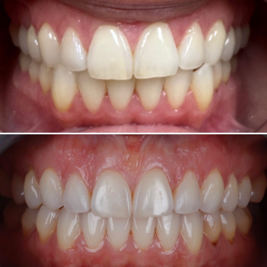 Clear Aligners