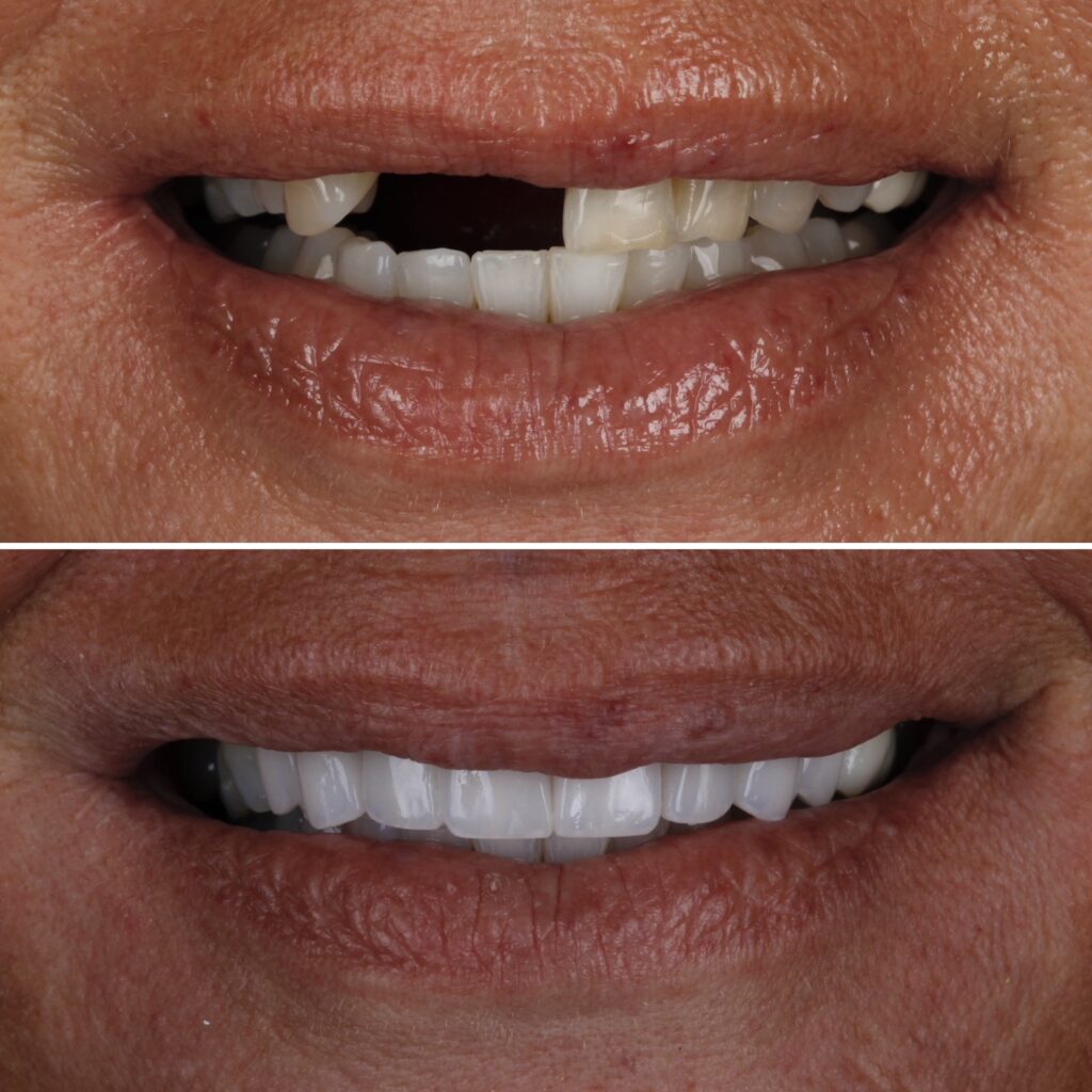 Veneers with Implants