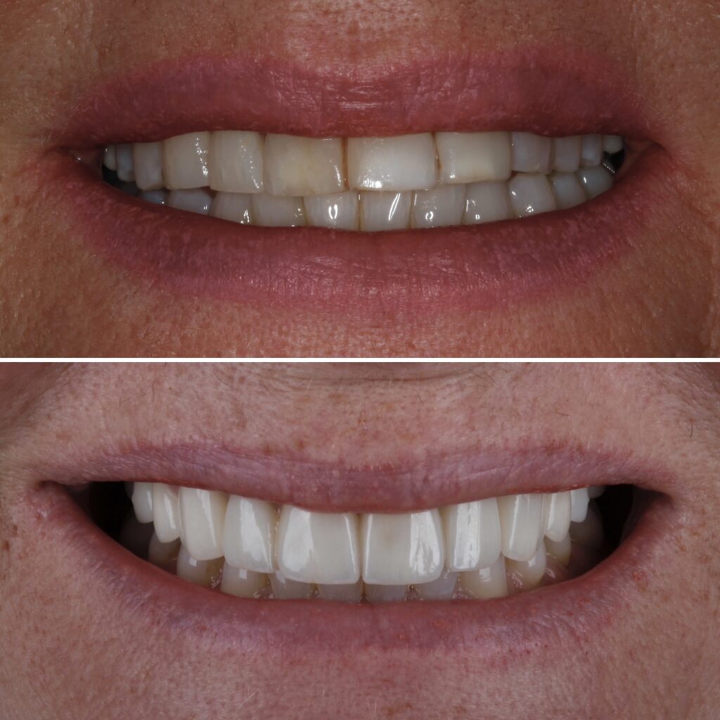 Veneers