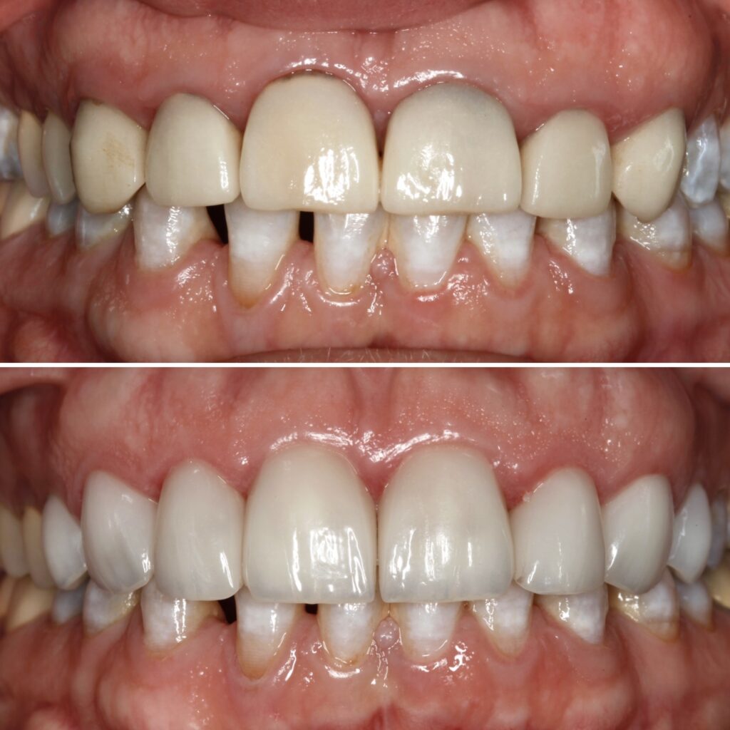 Crown Replacement