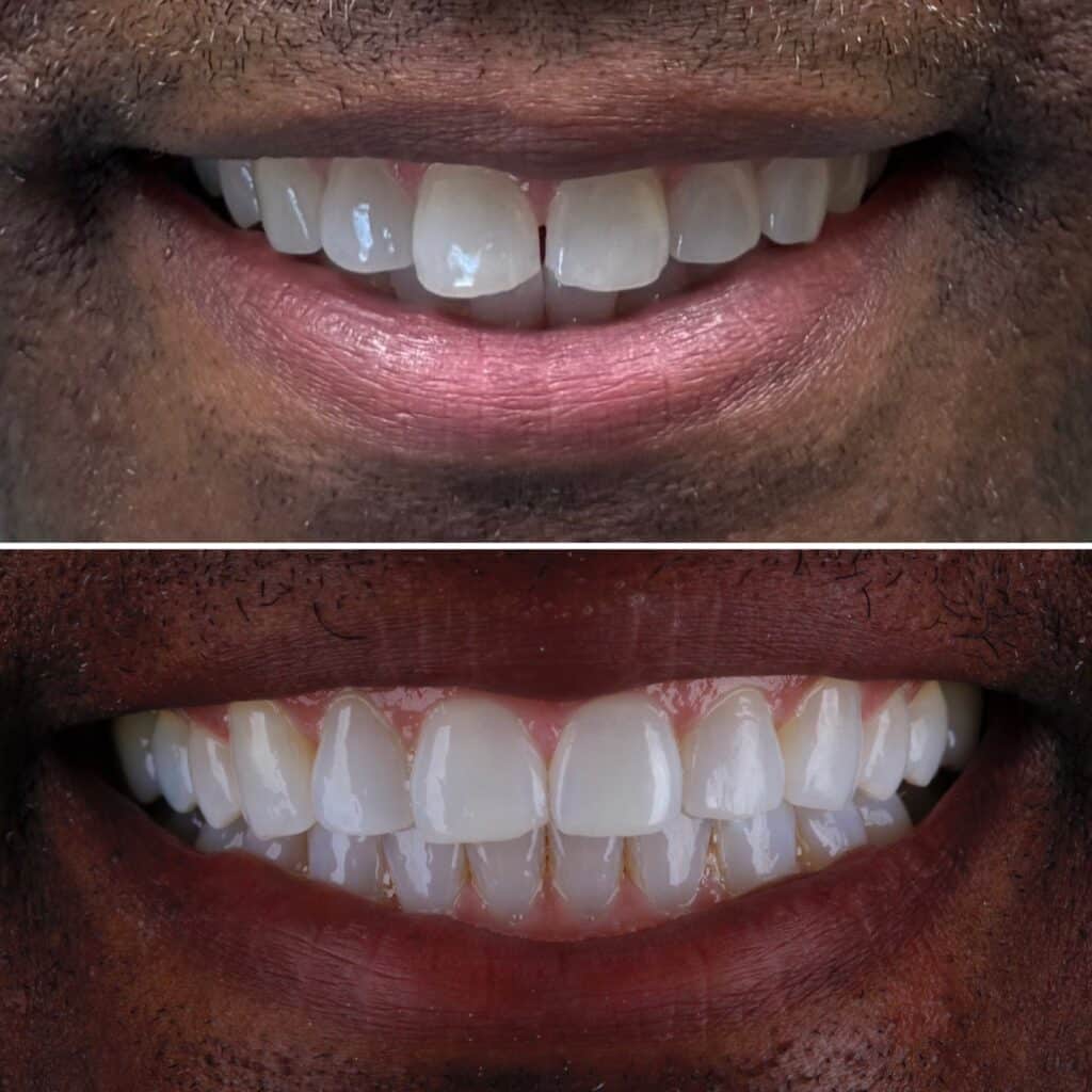 Invisalign
