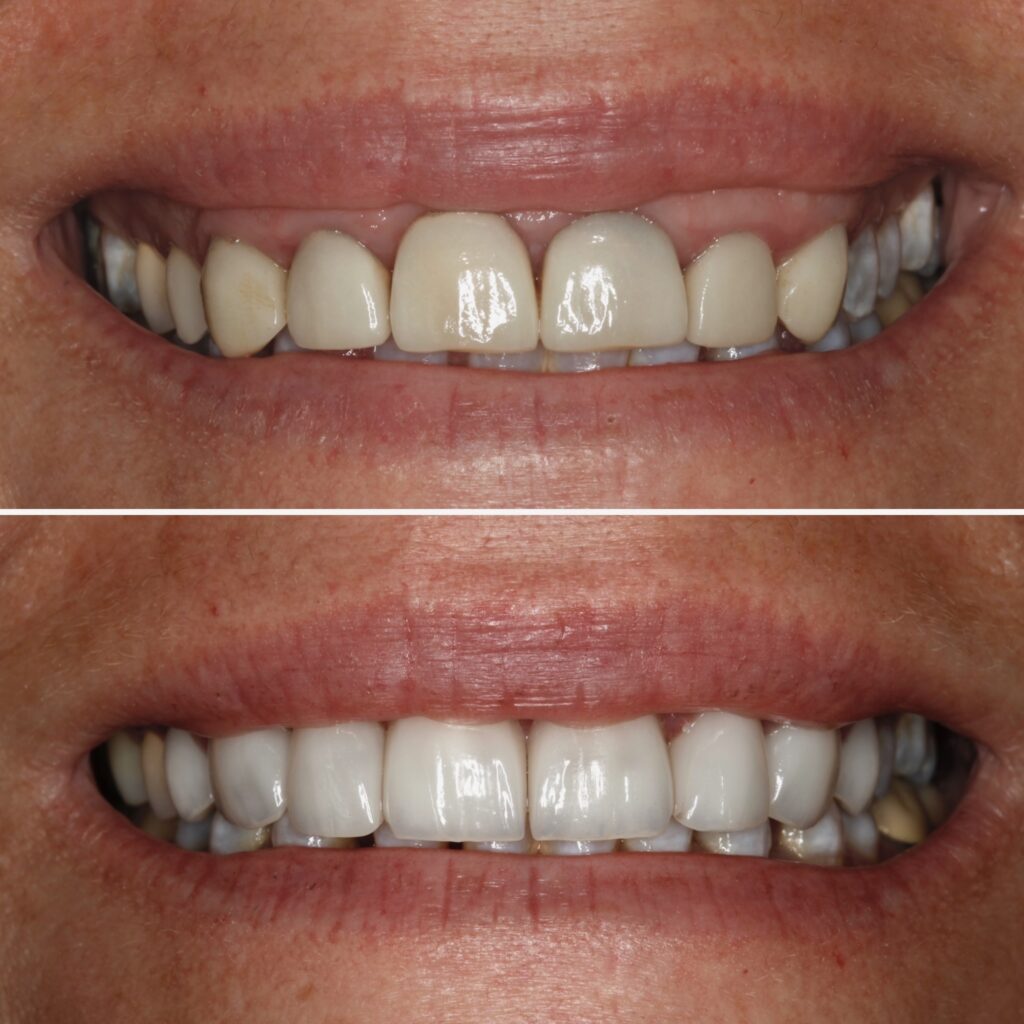 Replacing Old, Defective Crowns