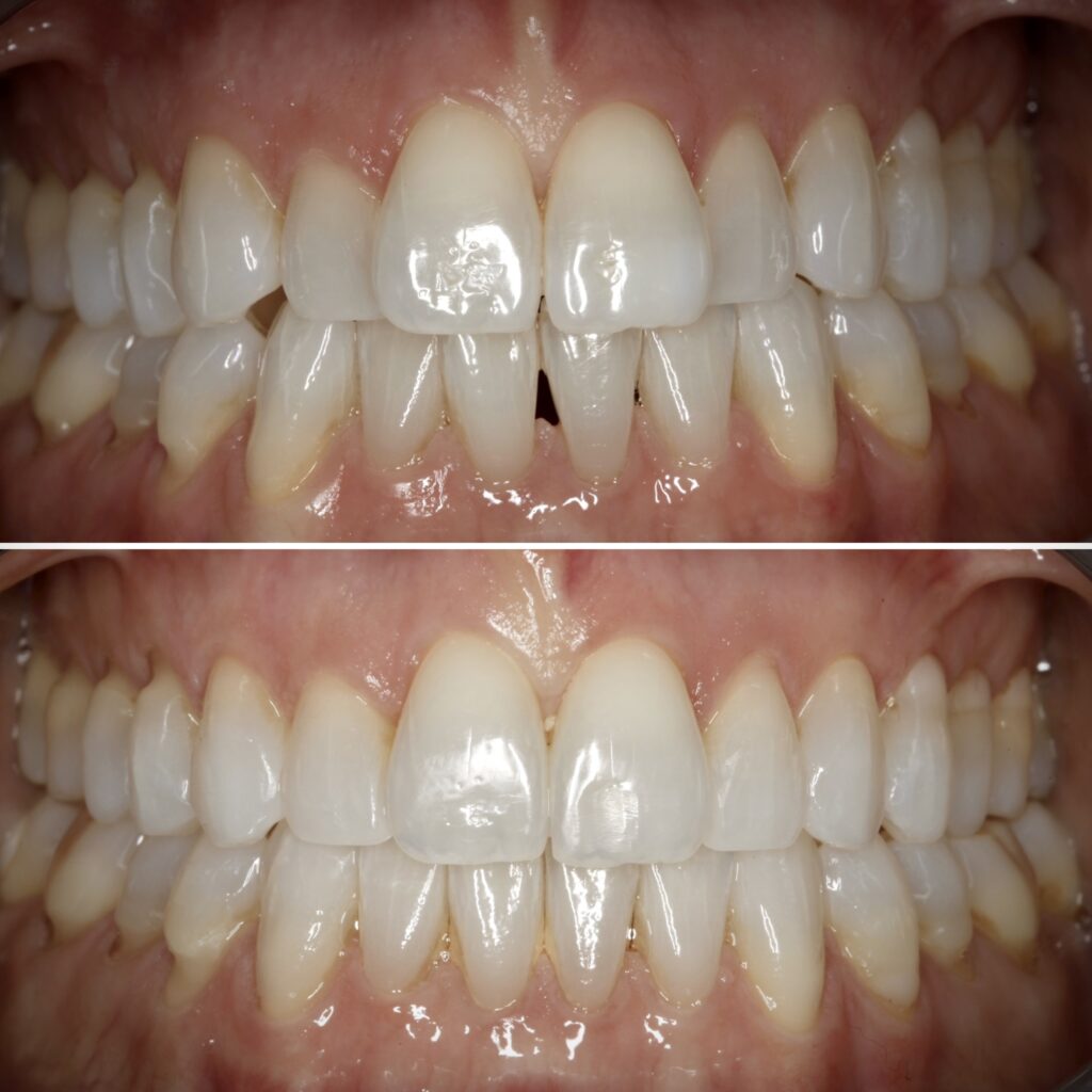 Invisalign