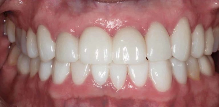 1-Full-Mouth-Rehab-Intraoral-1-e1665399672496-768x378