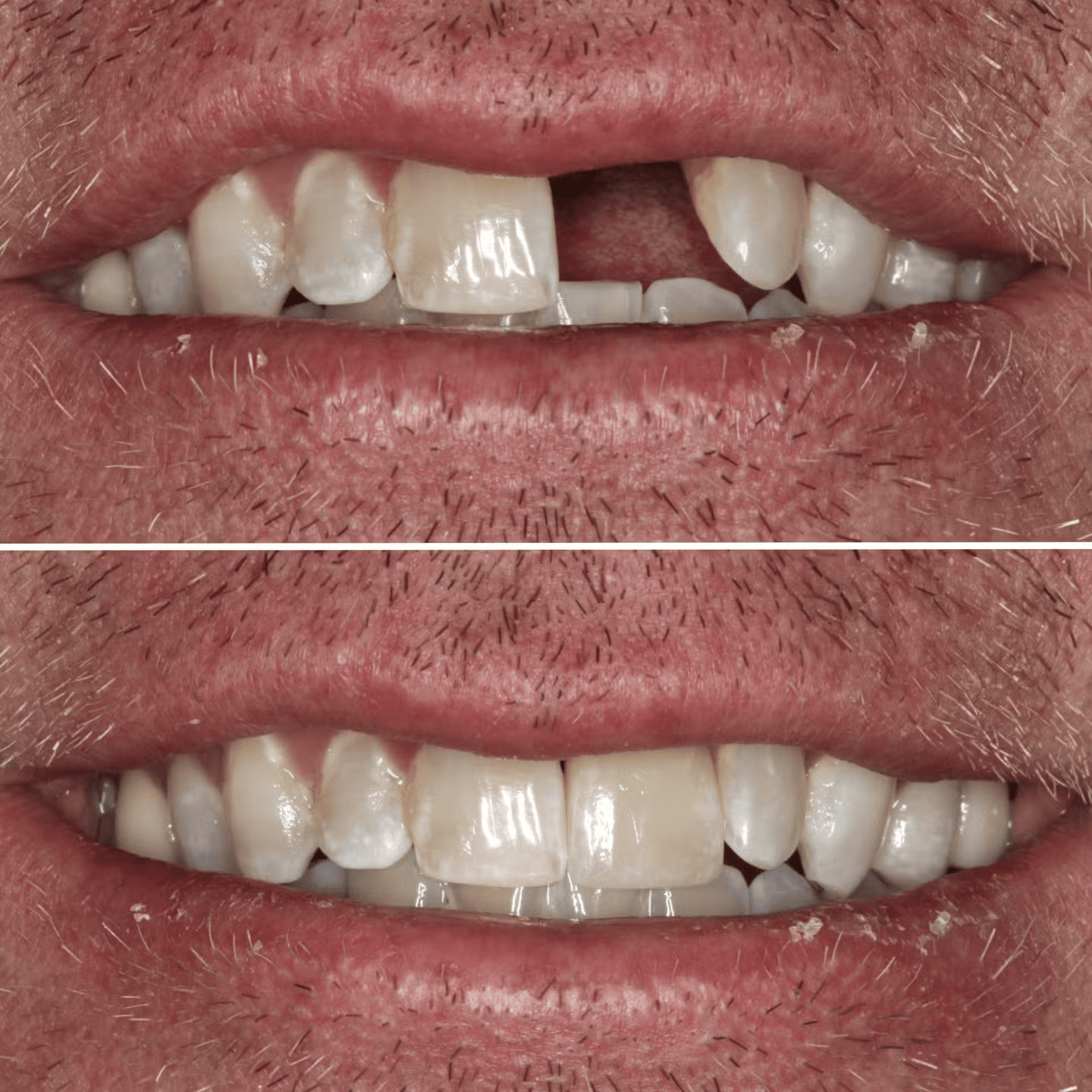 Single Implant and Cosmetic Crown