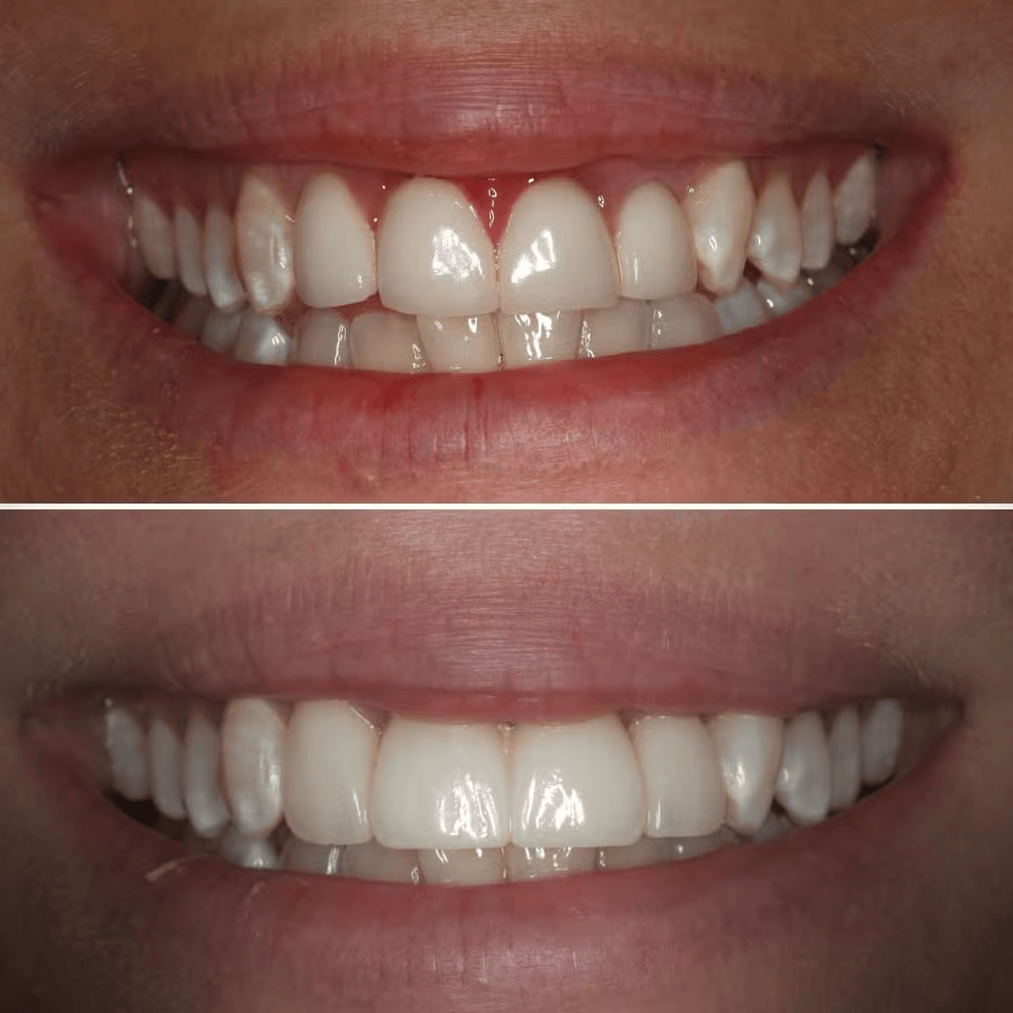 Veneer Replacement after Severe Gingivitis Cure