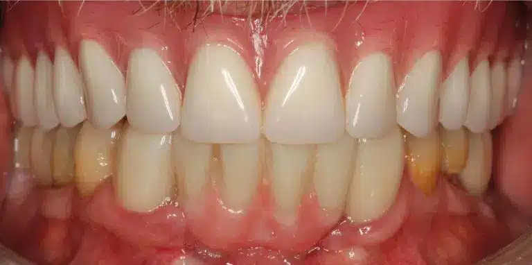 2-Implant-Rehab-Intraoral-1-e1665399926517-768x382.jpg