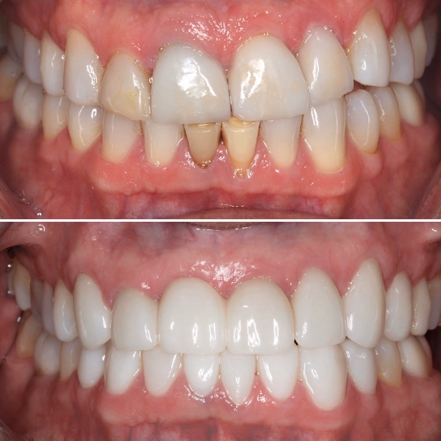 Comprehensive Full Mouth Rehabilitation