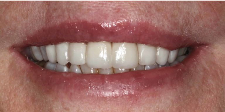 3-Layered-Zirconia-Extraoral-1-e1665402458105-768x384