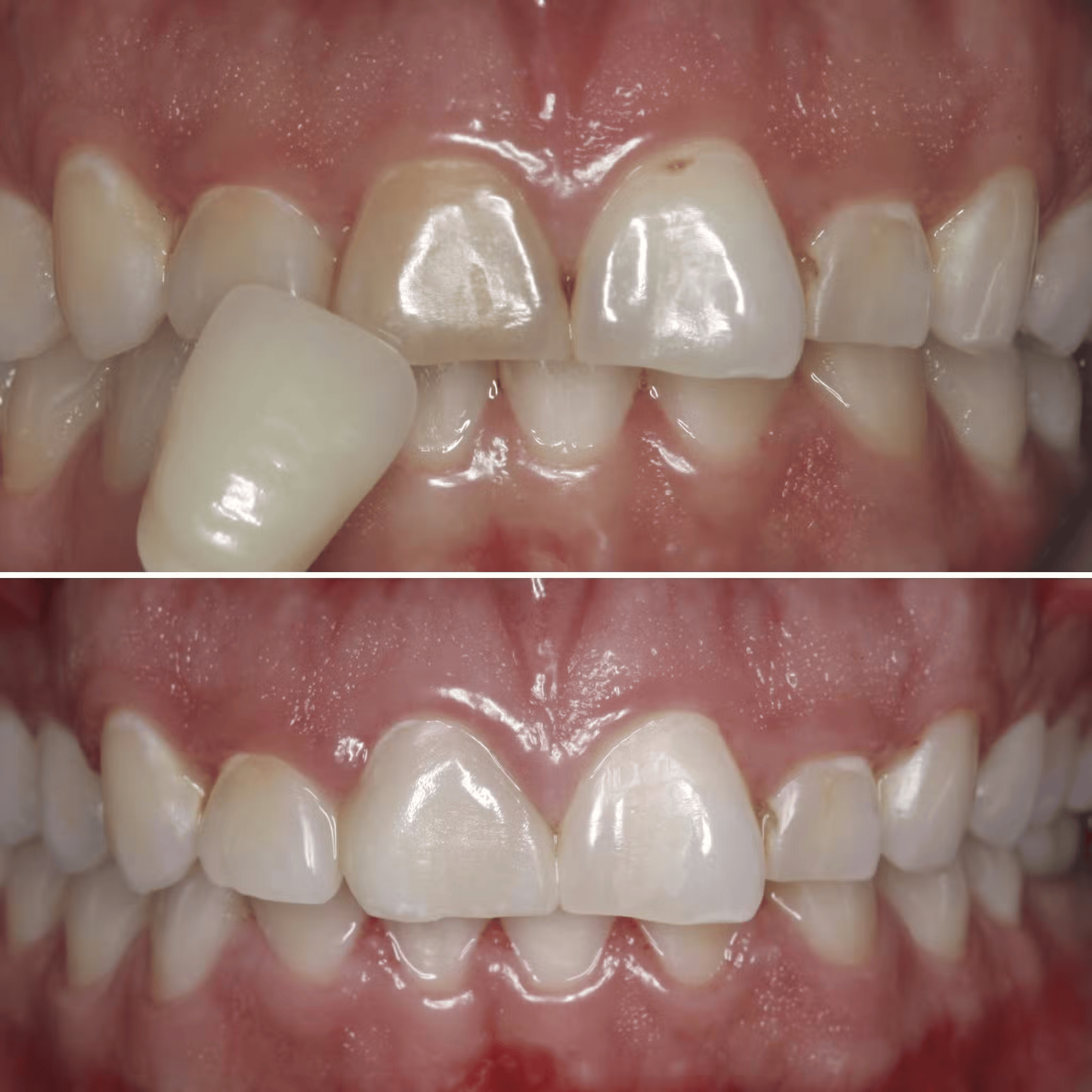 Single Veneer Dark Tooth