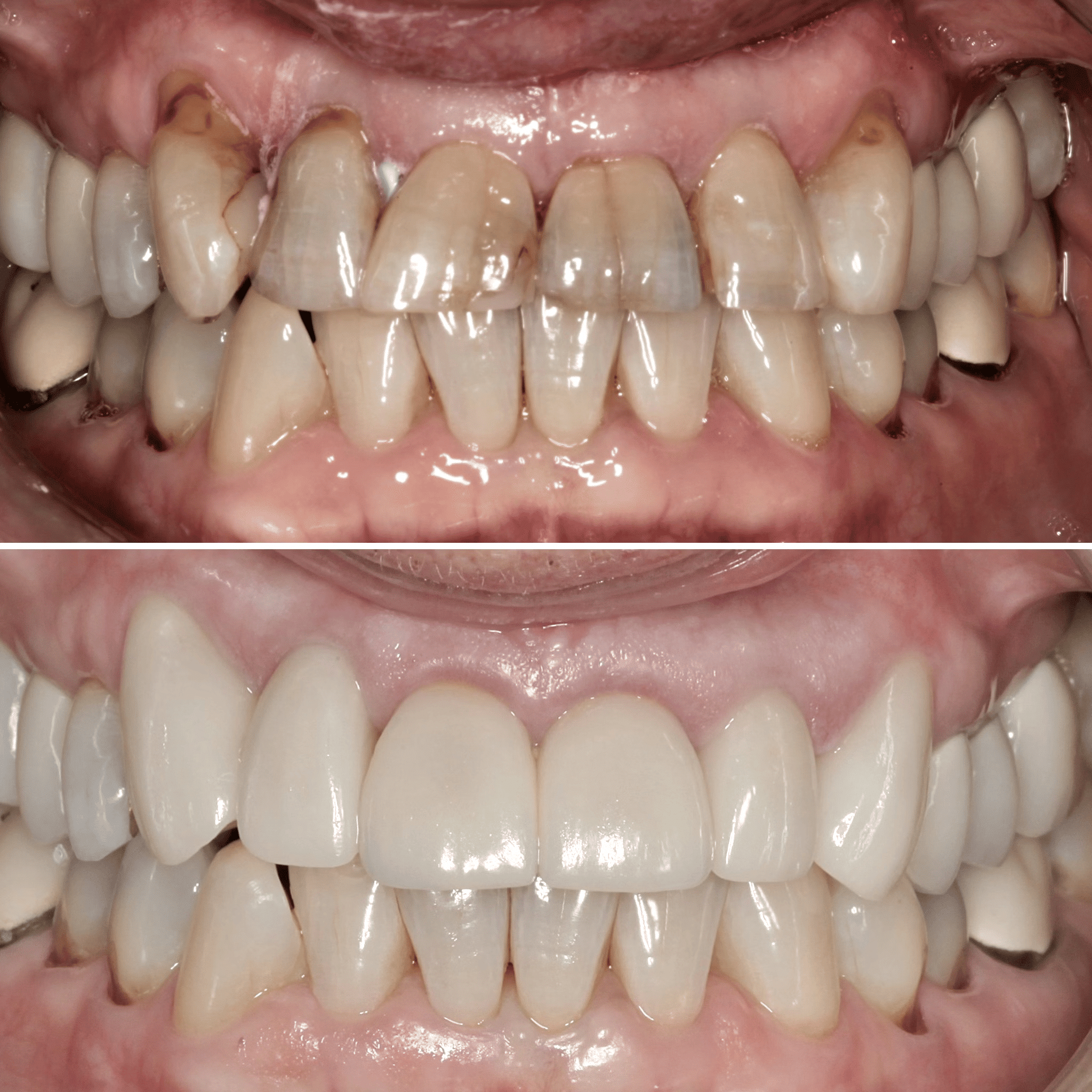 Fractured Teeth Repair