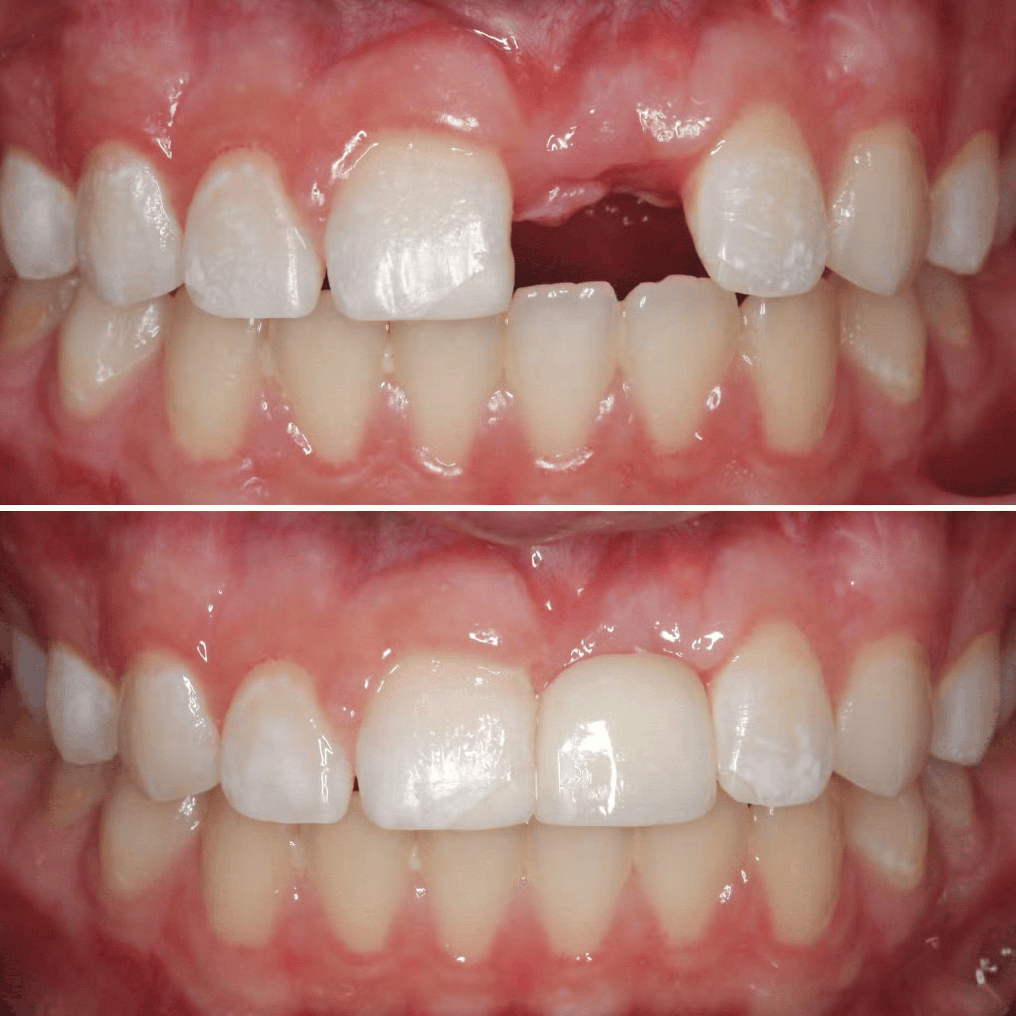 Replacement of Congenitally Missing Tooth