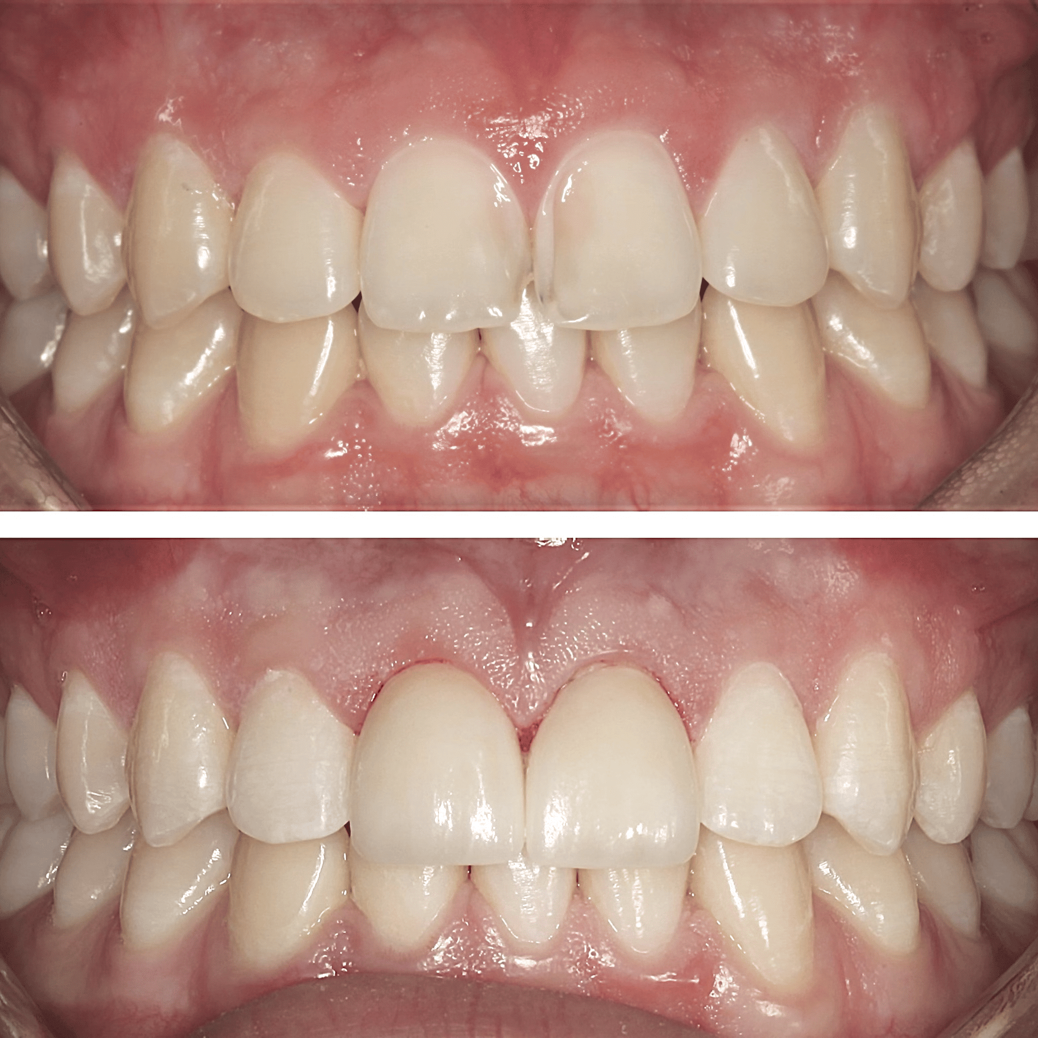 Two Veneers to repair congenital tooth defects