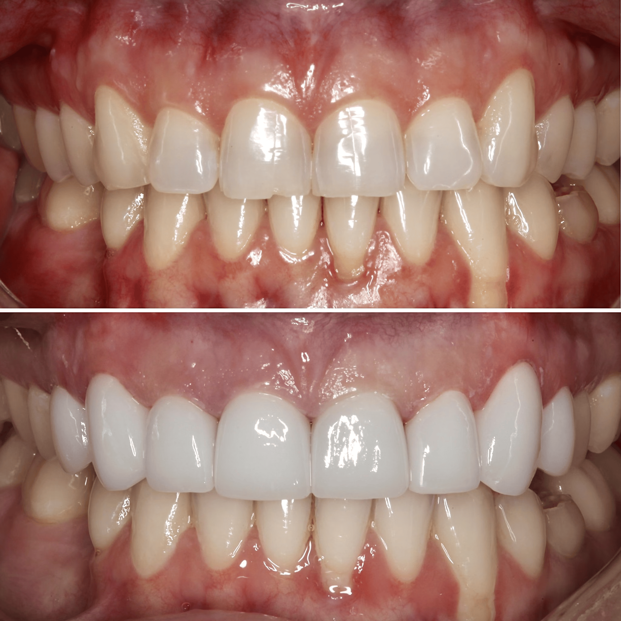 Bleach White Porcelain Veneers