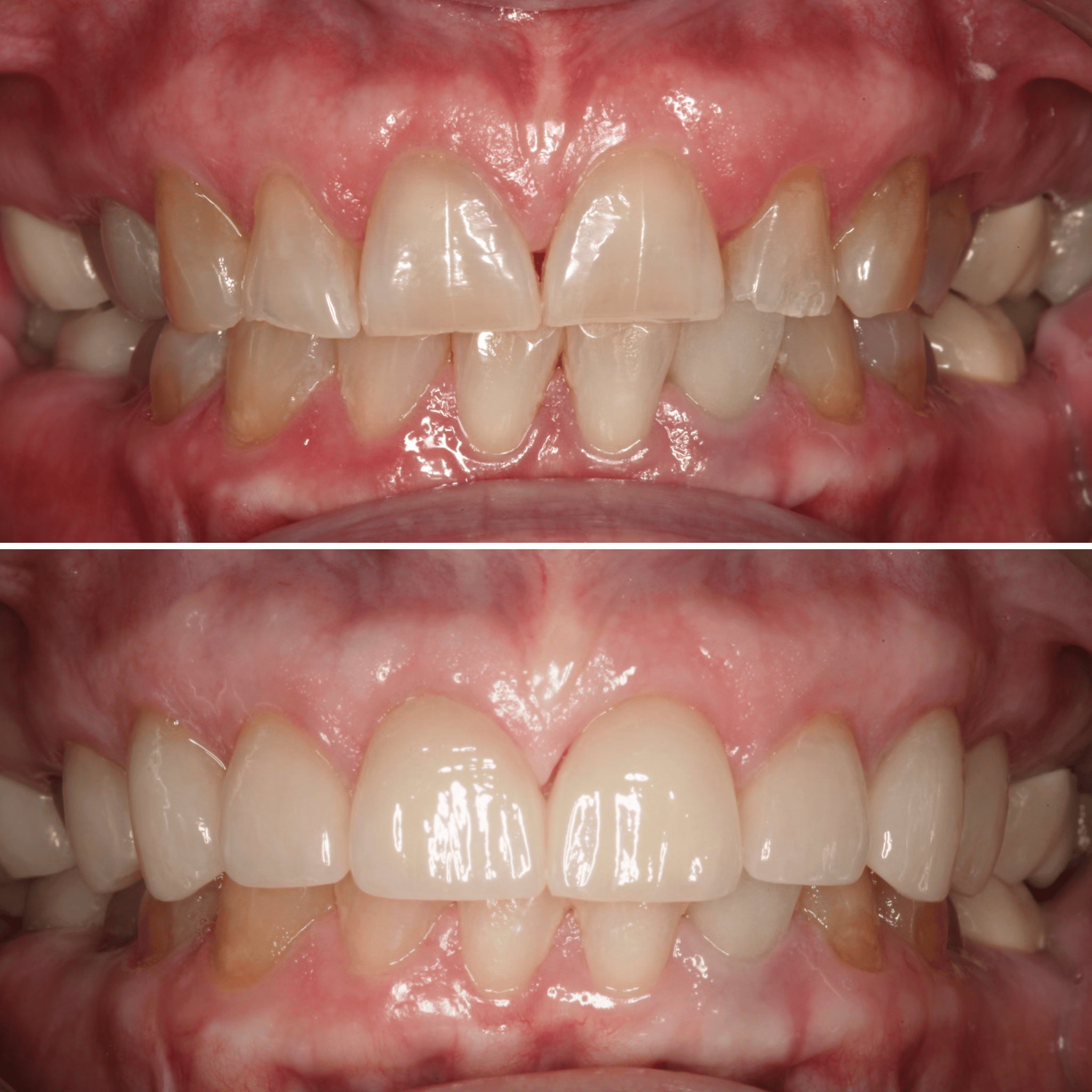 Worn Dentition Repair