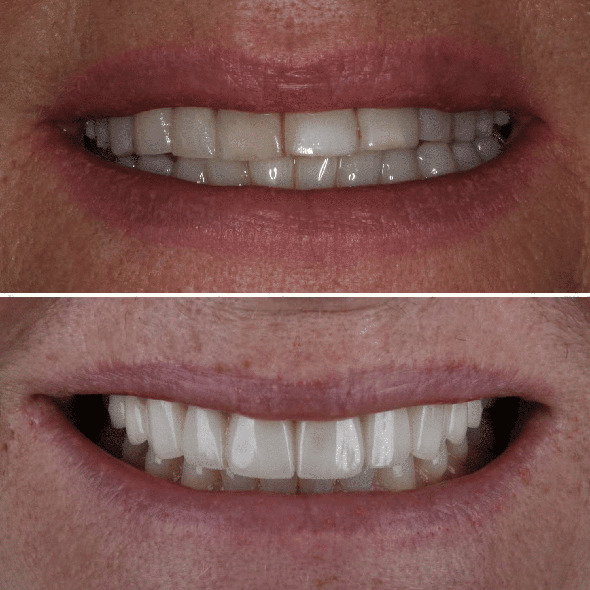 Composite Veneers to Porcelain Veneers
