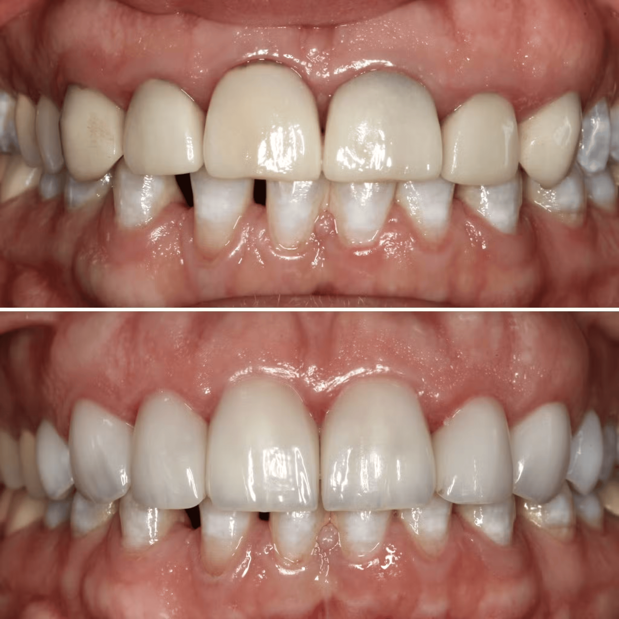 Replacing Old,  Defective Crowns
