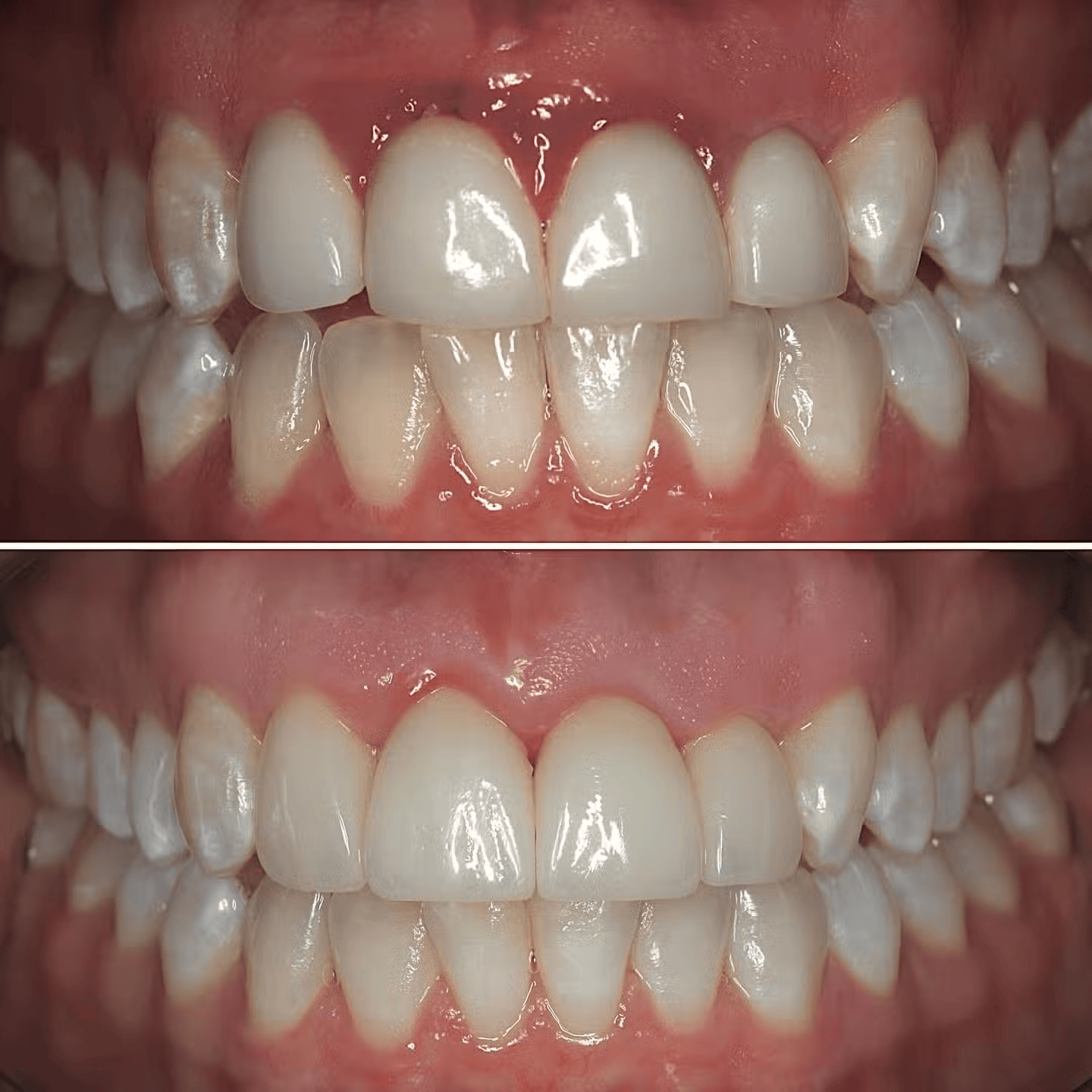 Veneer Replacement after Severe Gingivitis Cure #2