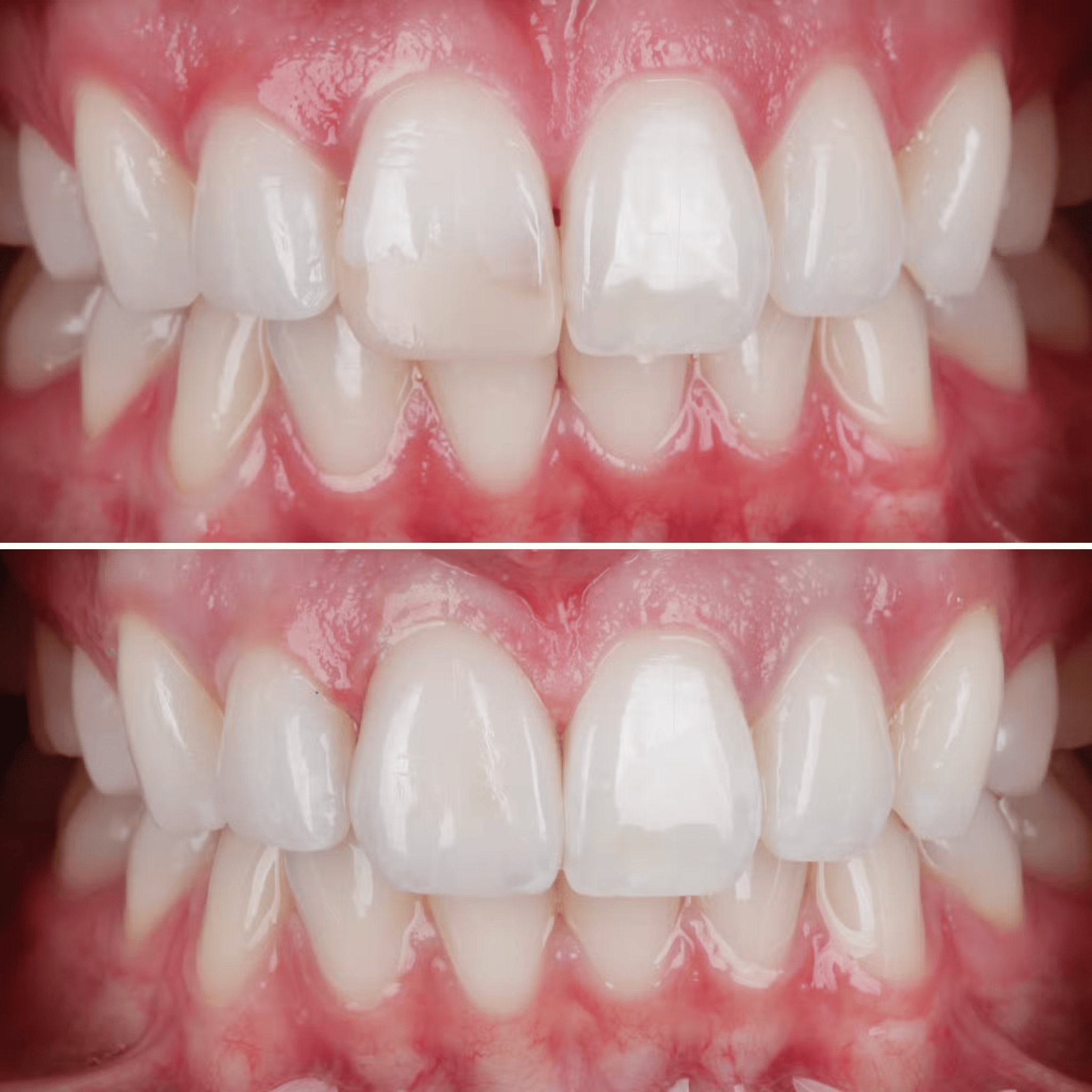 Single Veneer for Dark Front Tooth