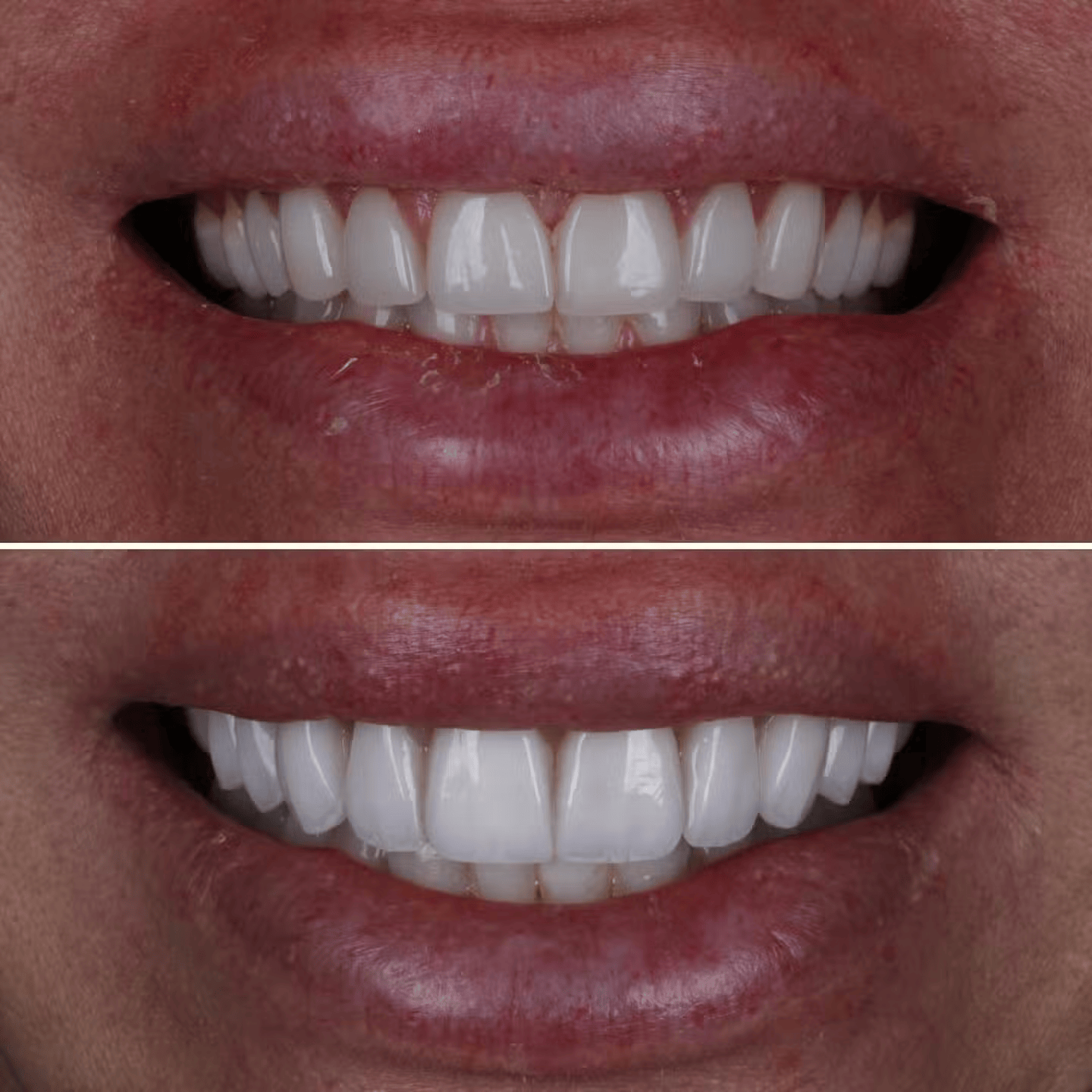 Veneer Replacement