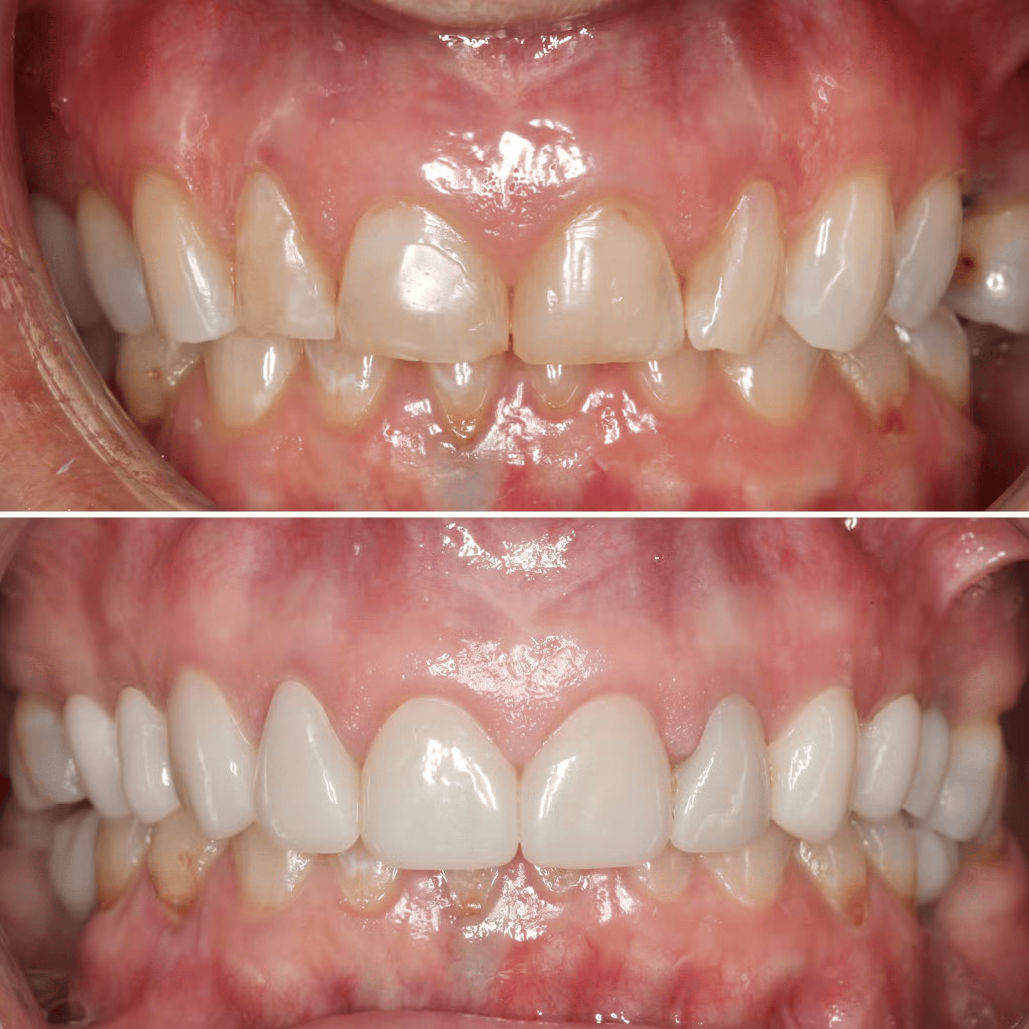 Gum Lift with Cosmetic Rejuvenation