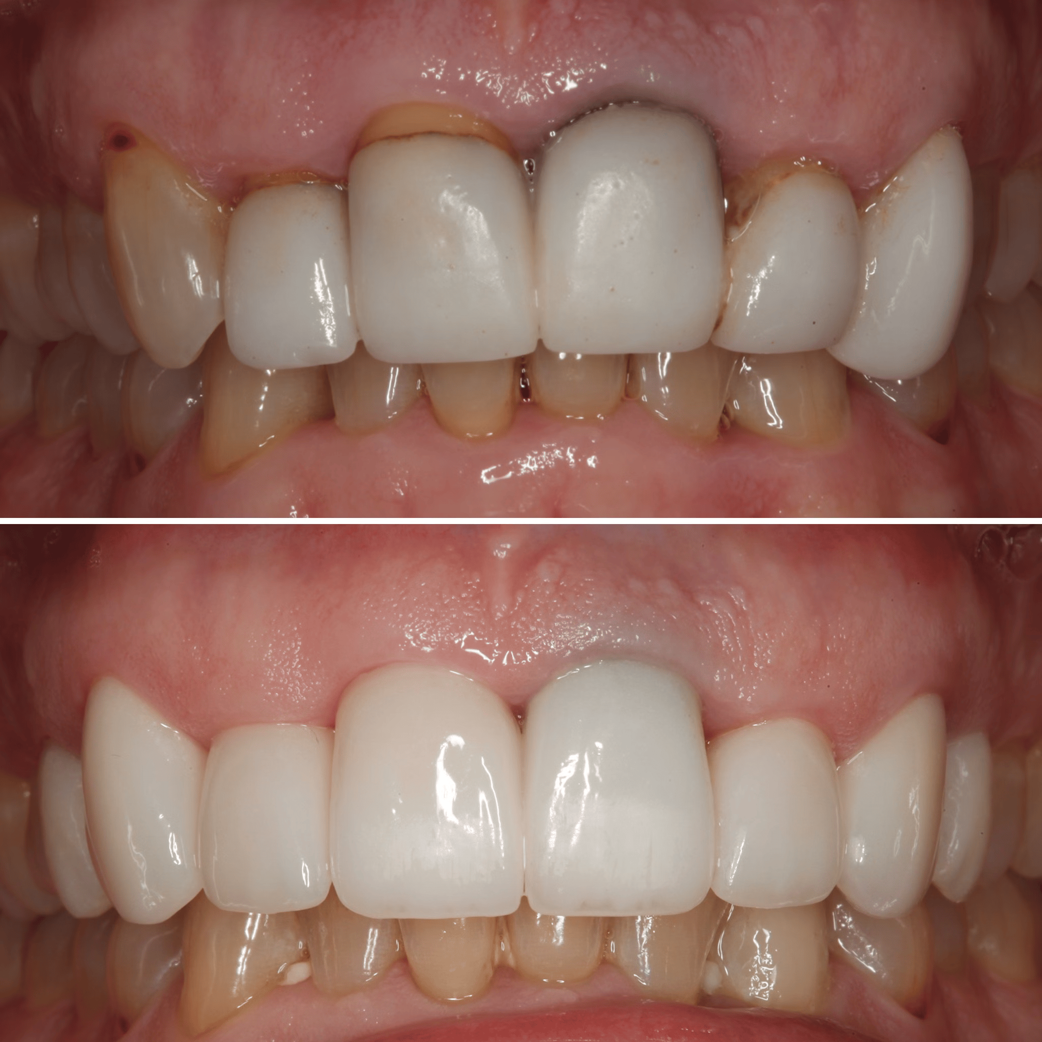 Cosmetic Rejuvenation/Veneer Replacement
