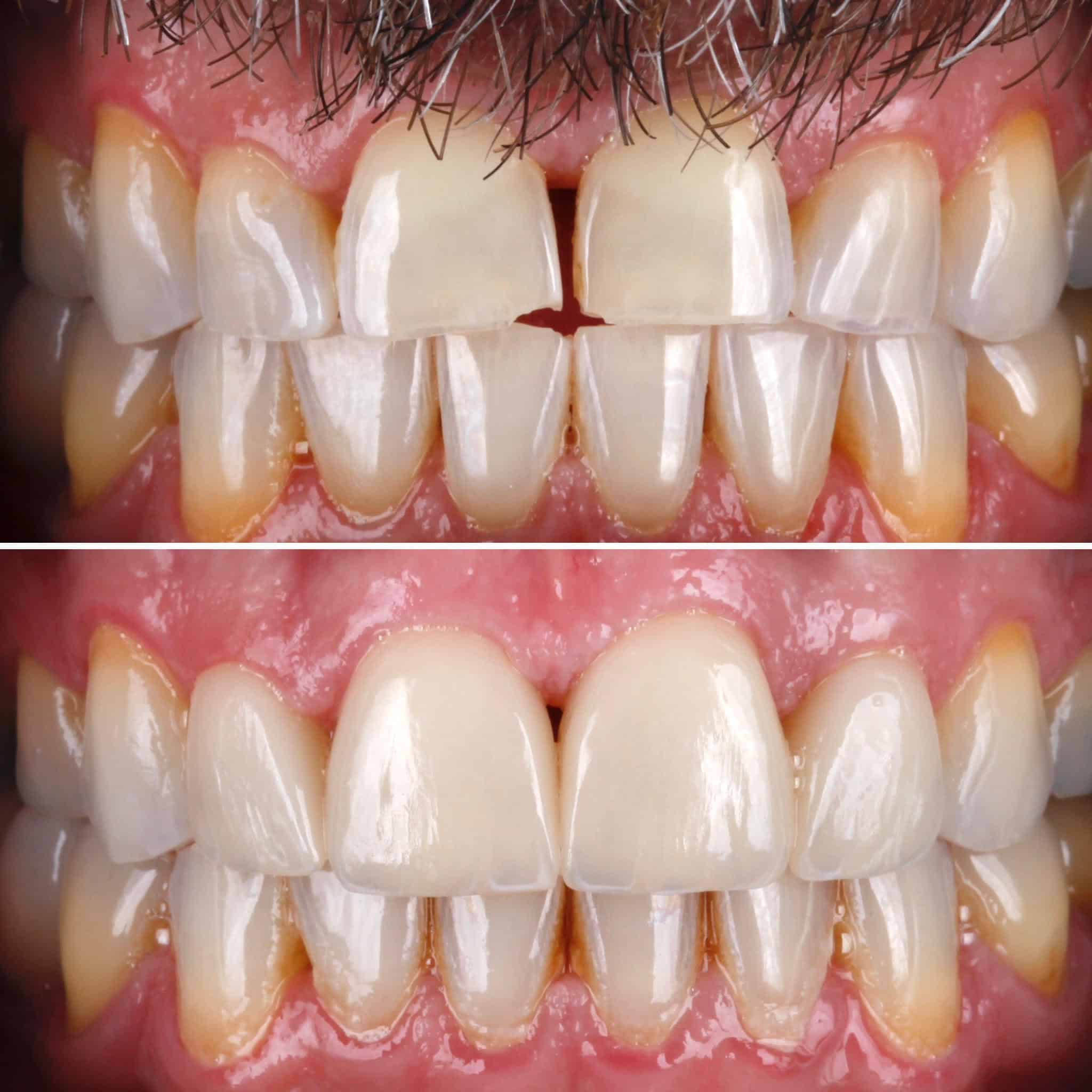 Veneer  Case 2