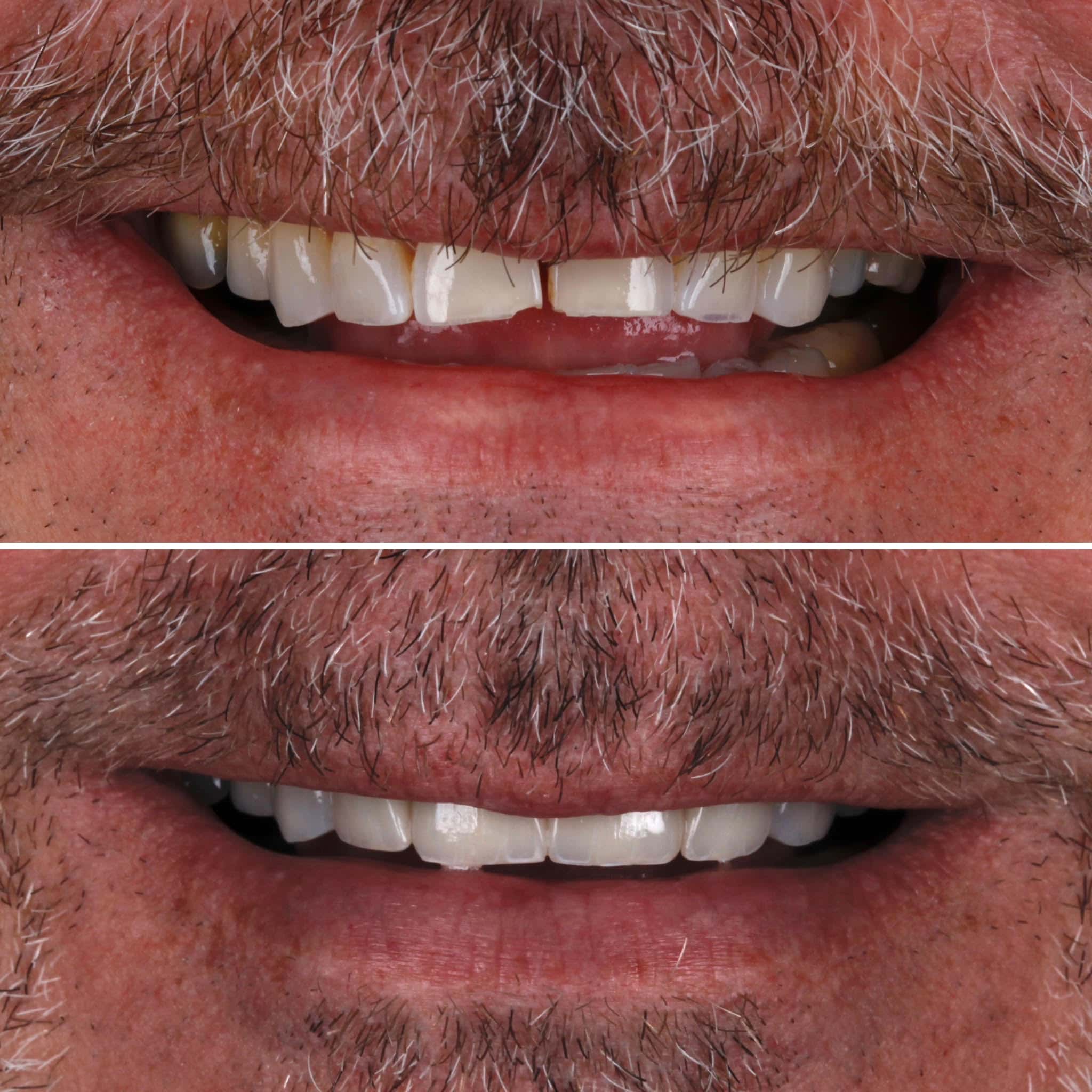 Veneer  Case 1