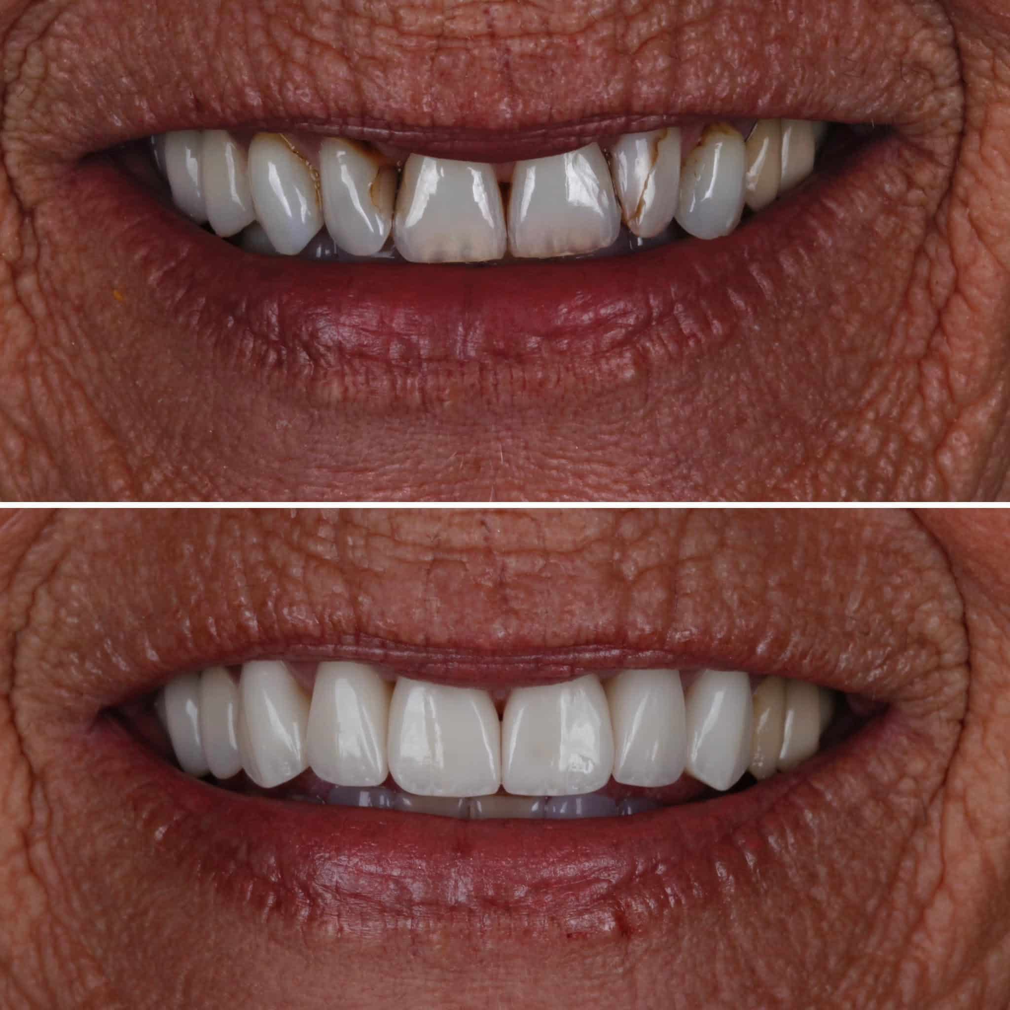 Veneer  Case 3