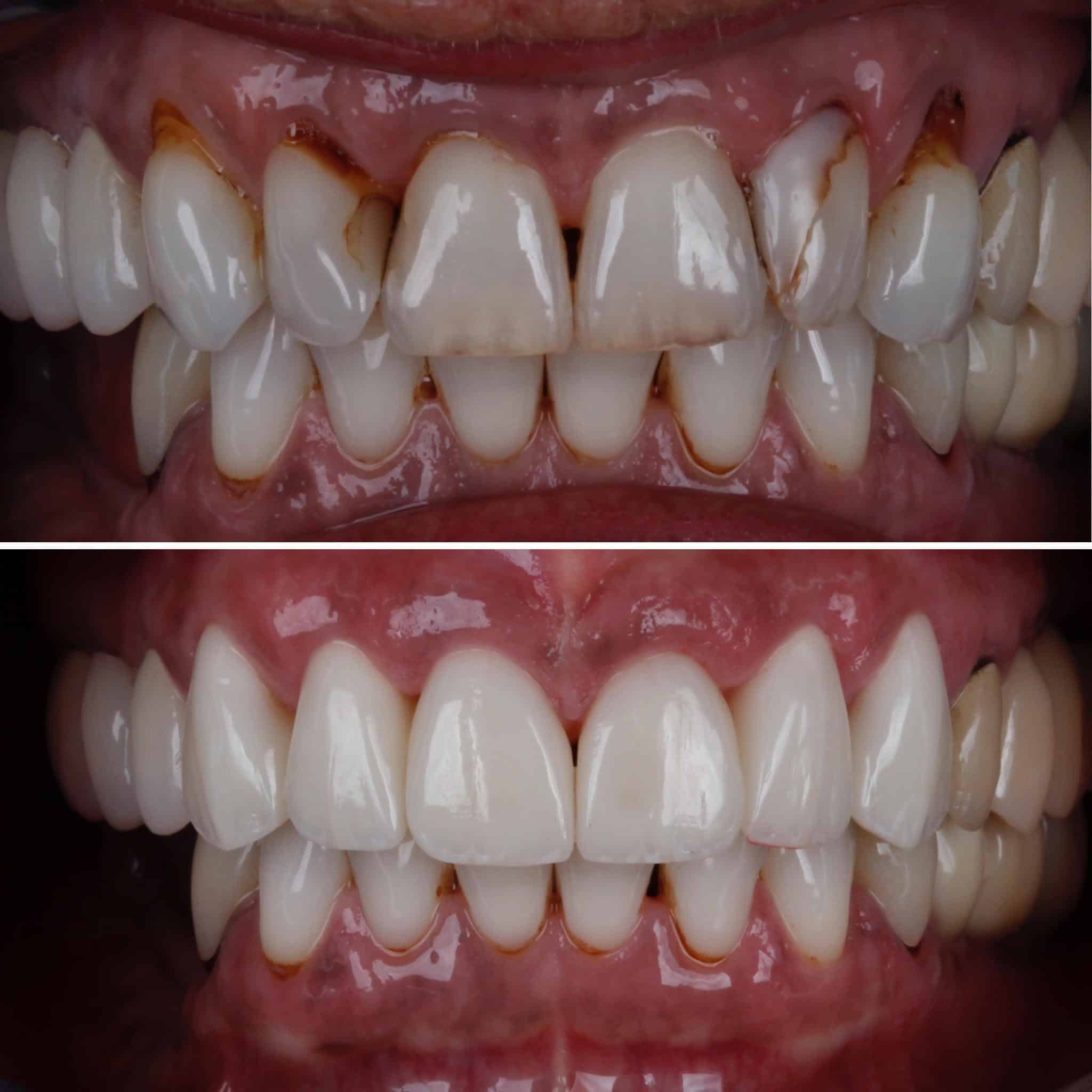 Veneer  Case 4