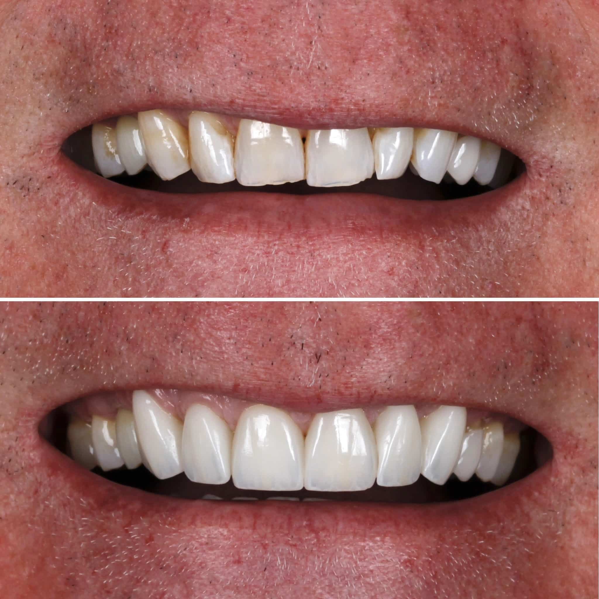 Veneer  Case 5