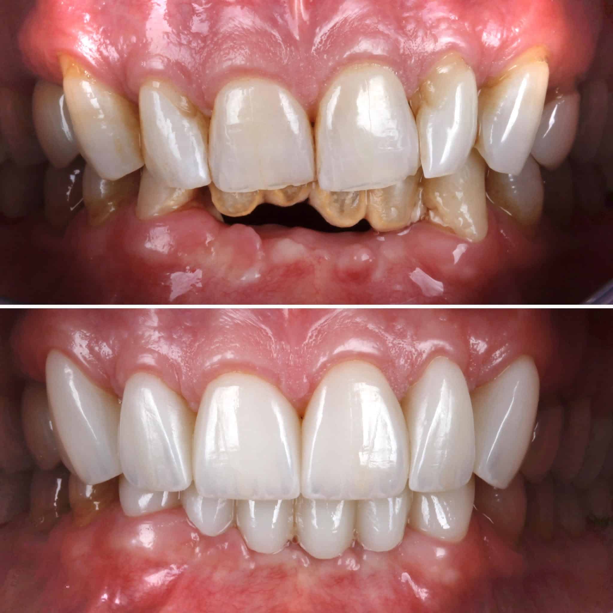 Veneer  Case 6