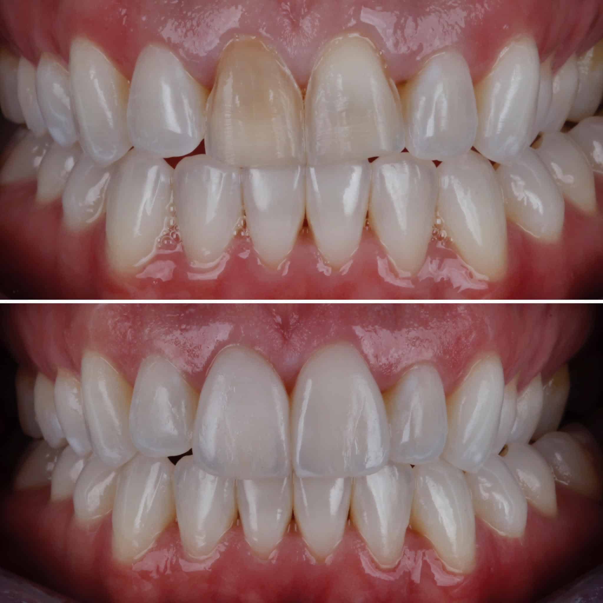 Veneer  Case 7