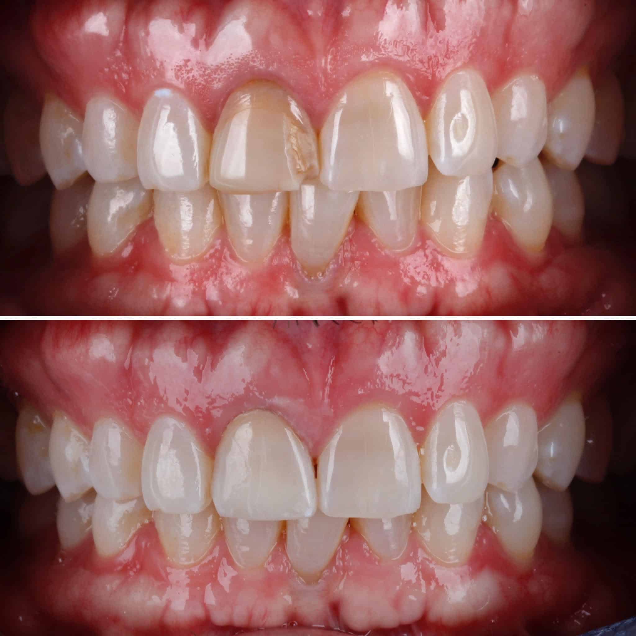 Veneer  Case 8